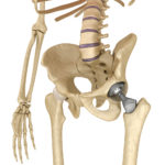 image-of-hip-replacement