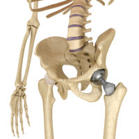 image-of-hip-replacement image-of-hip-replacement
